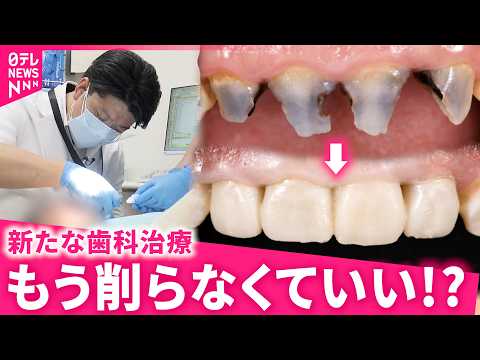 【スゴい！】常識を変える歯科治療！歯を"削らずに"治す最新技術 開発者の思い　徳島　NNNセレクション