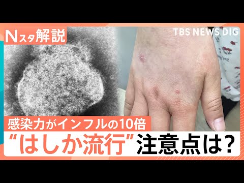 はしか「発症の1日前から感染力」「風邪のような症状のあとに発疹」26～53歳は特に注意！ワクチン接種歴の確認を【Nスタ… サムネイル