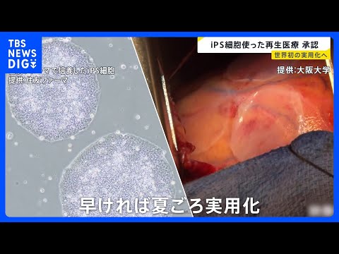 世界初の実用化へ iPS細胞を使った2つの再生医療製品 条件期限付きで承認　早ければ今夏にも【news23】｜TBS… サムネイル